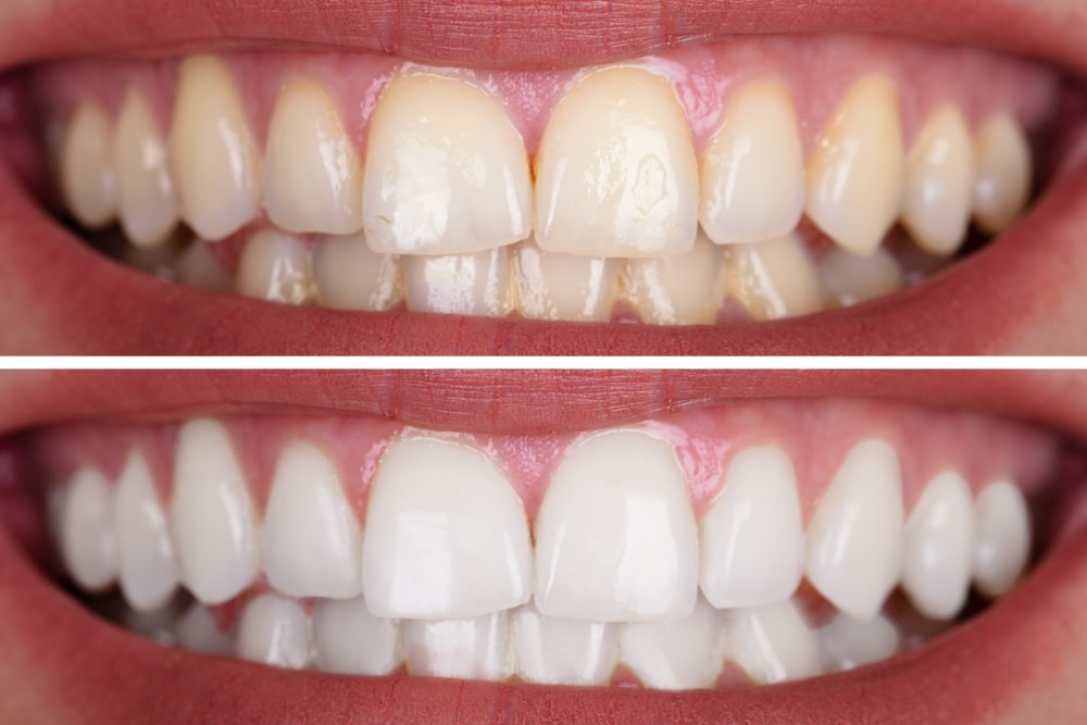 Teeth Whitening in las vegas