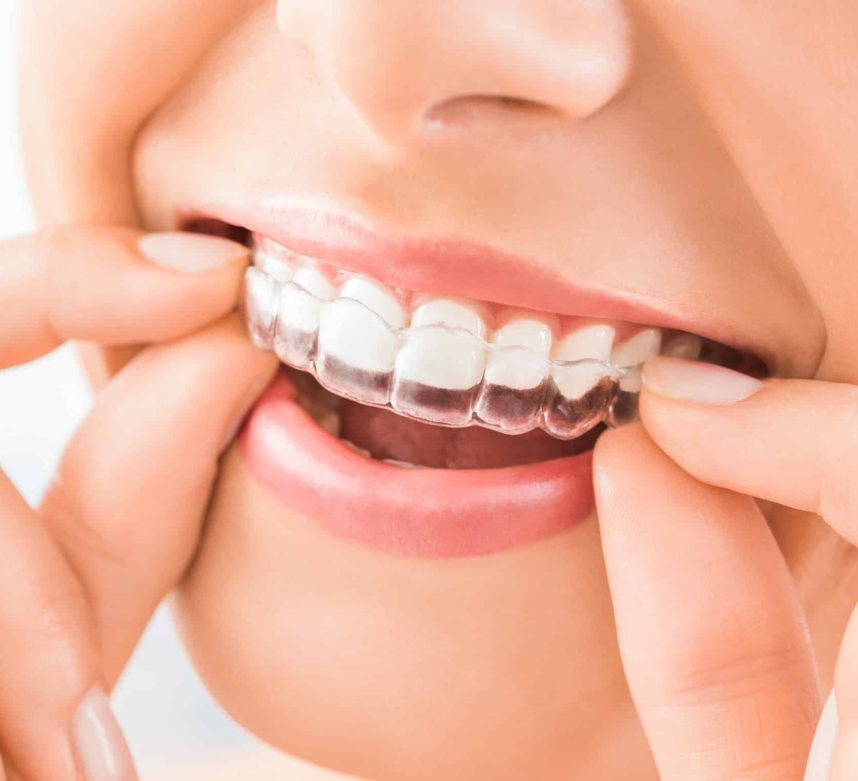 https://thedentistlv.com/wp-content/uploads/2024/06/invisalign-applying.jpg