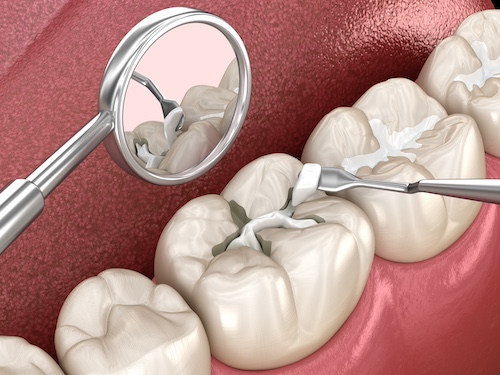 Molar,Tooth,Fissure,Restoration,With,Filling.,Medically,Accurate,Tooth,3d